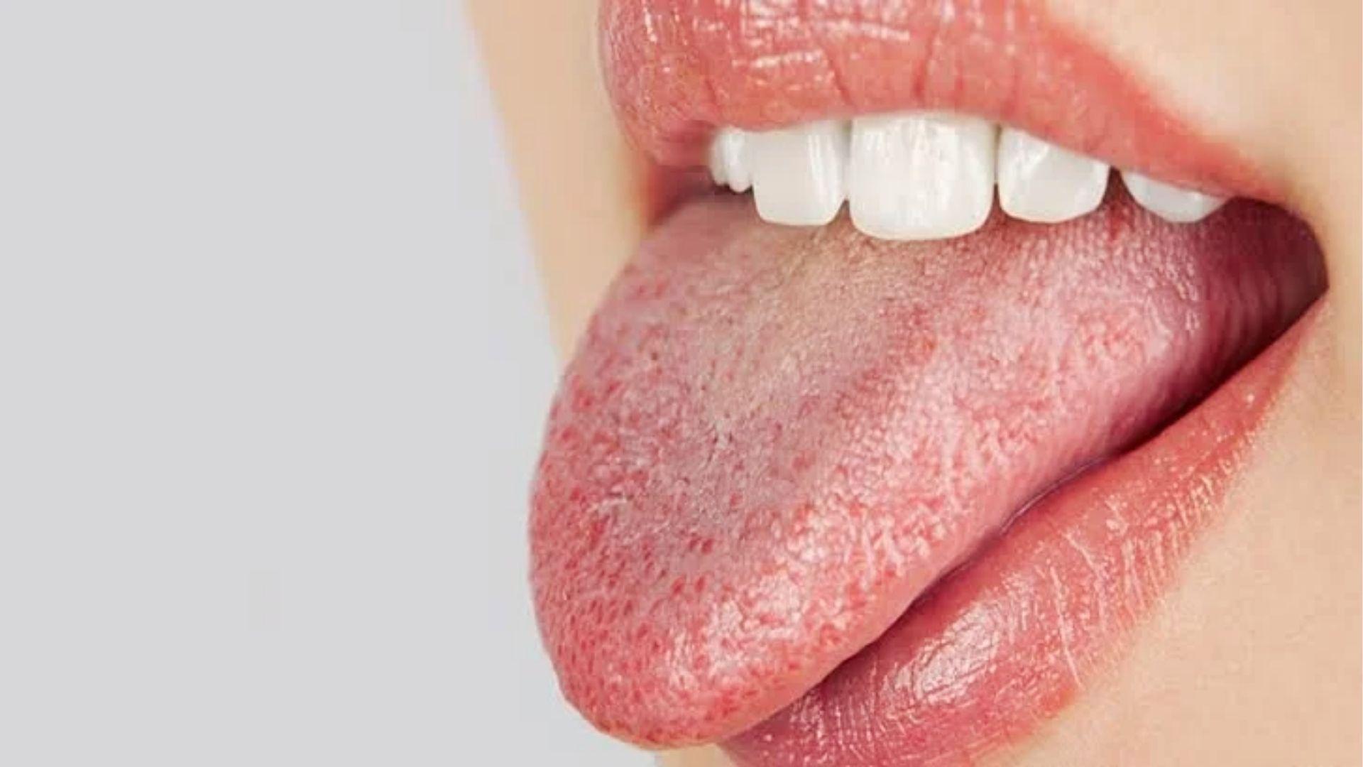 Close-up of dry tongue showing symptoms of cotton mouth and dehydration commonly experienced after taking THC cannabis edibles